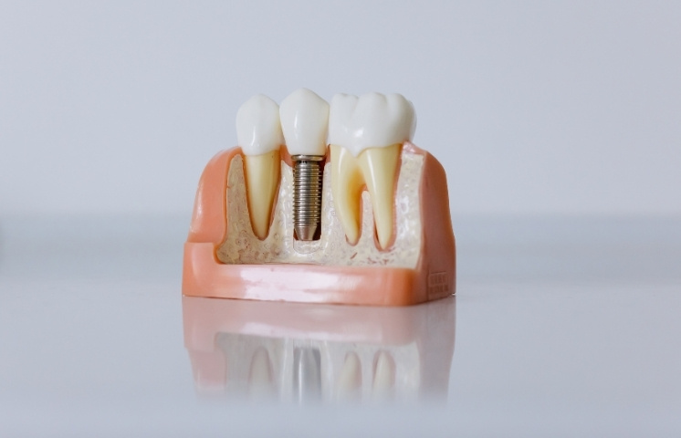 step-by-step dental implant process explained
