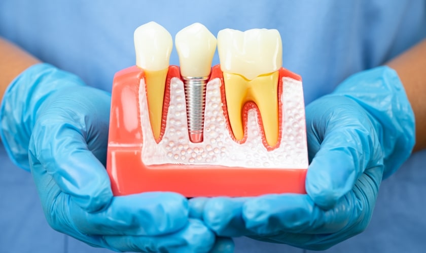 dental implants in Fort Lauderdale