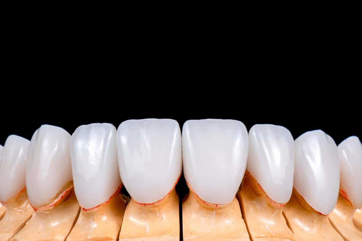 porcelain-veneers-in-Fort-Lauderdale